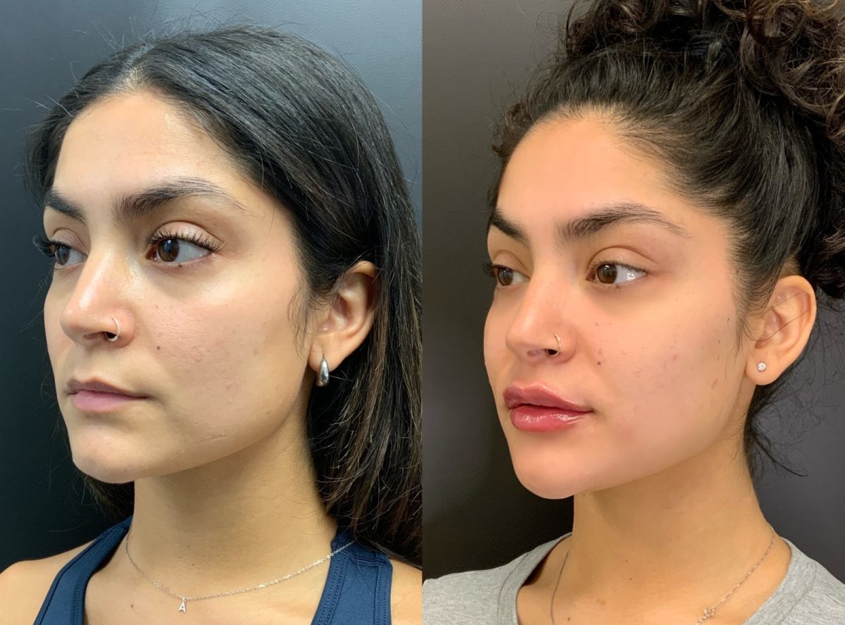 Lips & Chin Filler: before and after, Facial Balancing at Chin Up Aesthetics