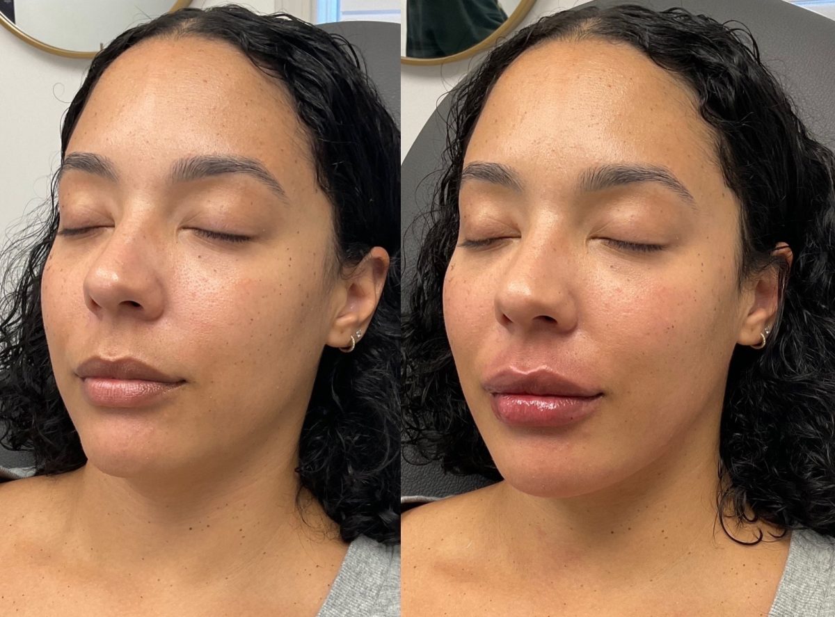 Lips & Chin Filler: before and after, Facial Balancing at Chin Up Aesthetics