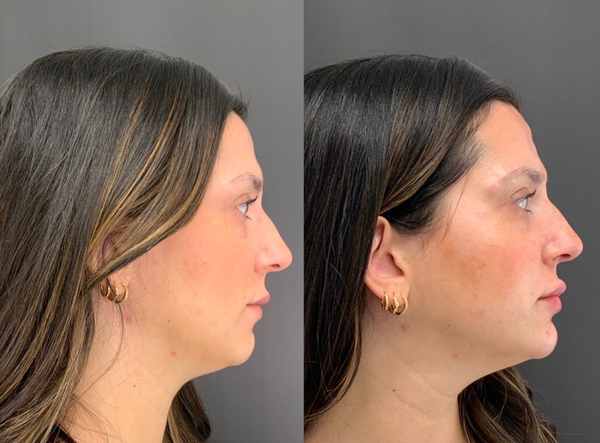 Lips and Chin w/ dermal filler: before and after, Facial Balancing at Chin Up Aesthetics