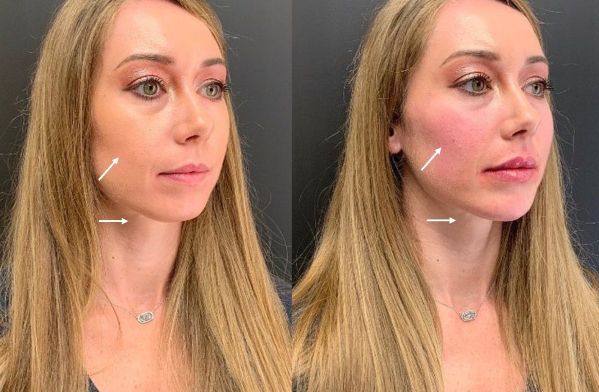 Lips, Chin, Cheeks: before and after, Facial Balancing at Chin Up Aesthetics