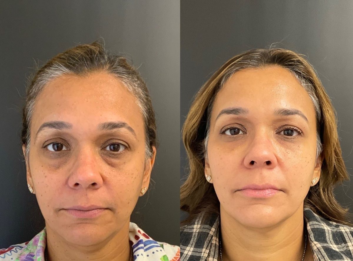 Midface Support: before and after, Facial Balancing at Chin Up Aesthetics