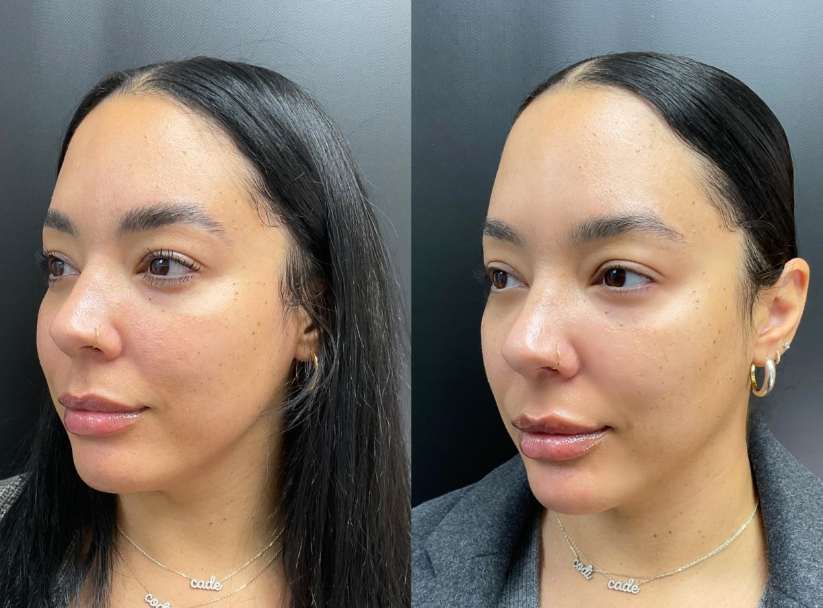 Profile Balancing: before and after, Facial Balancing at Chin Up Aesthetics