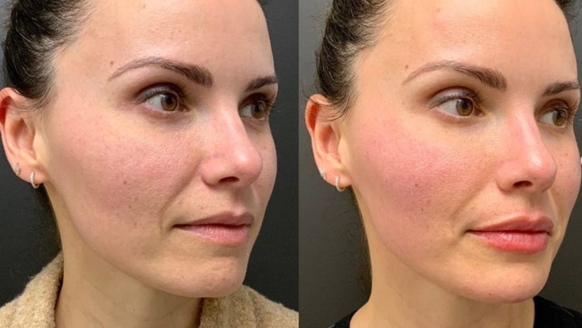 Sculptra & Dermal Filler: before and after, Facial Balancing at Chin Up Aesthetics