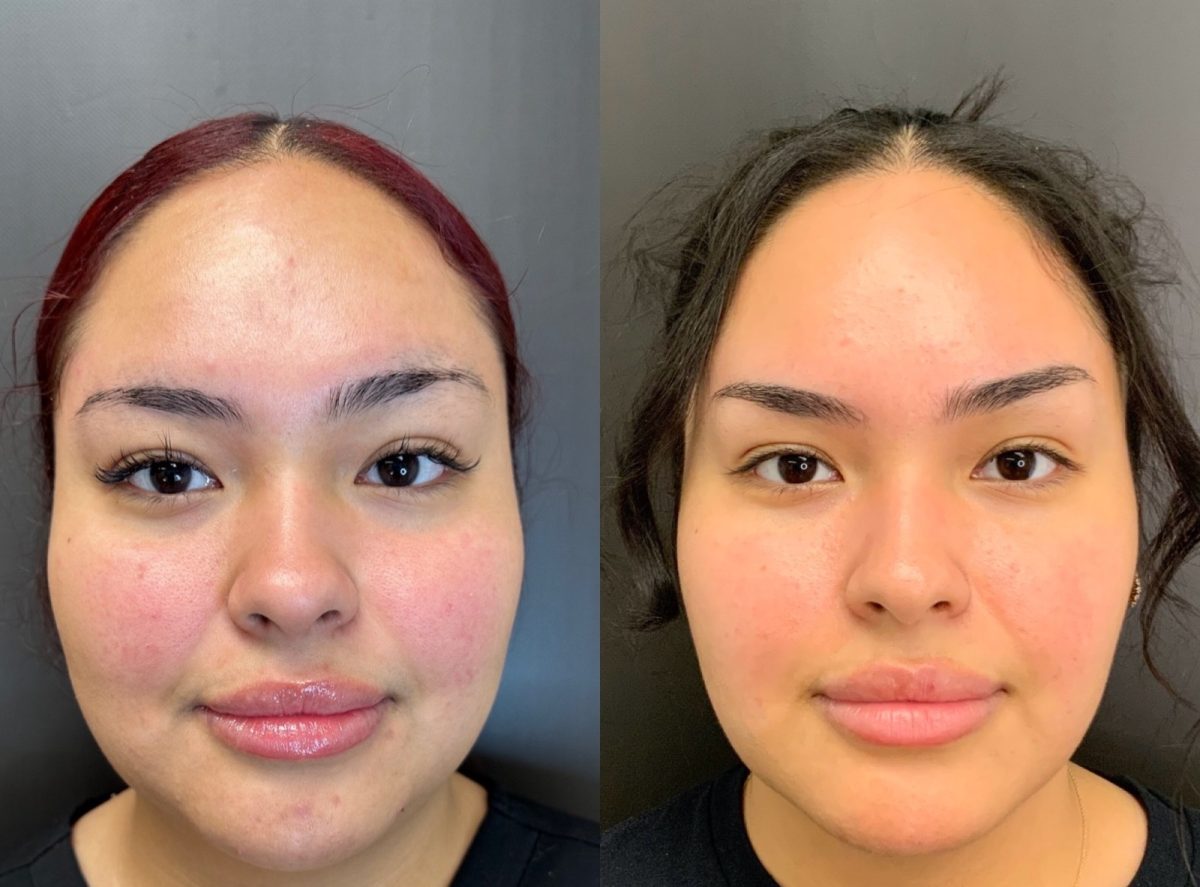 Facial Balancing & Medical Grade Skincare: before and after, Facial Balancing at Chin Up Aesthetics