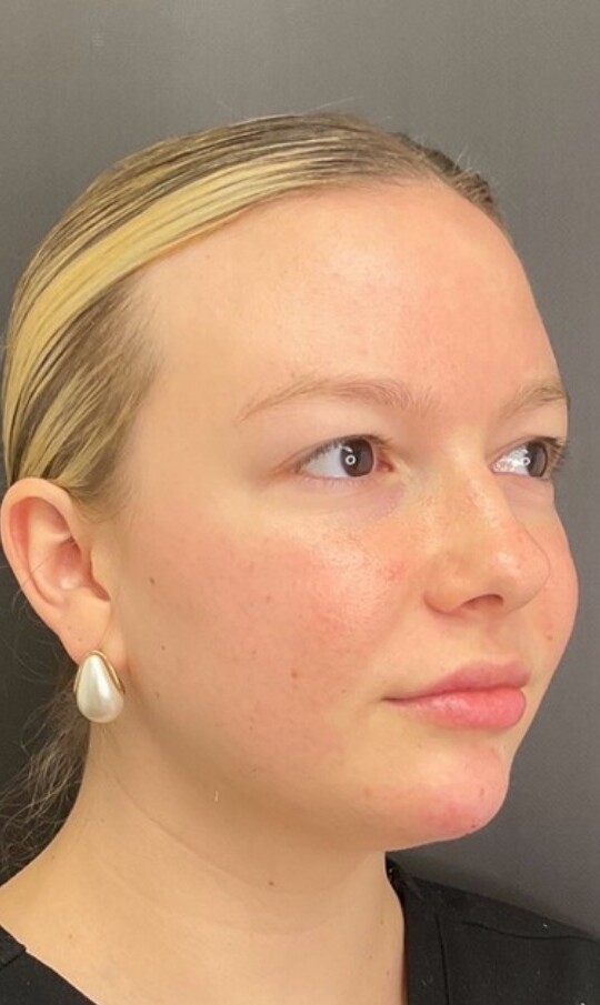 Facial Balancing + Skincare: after at Chin Up Aesthetics
