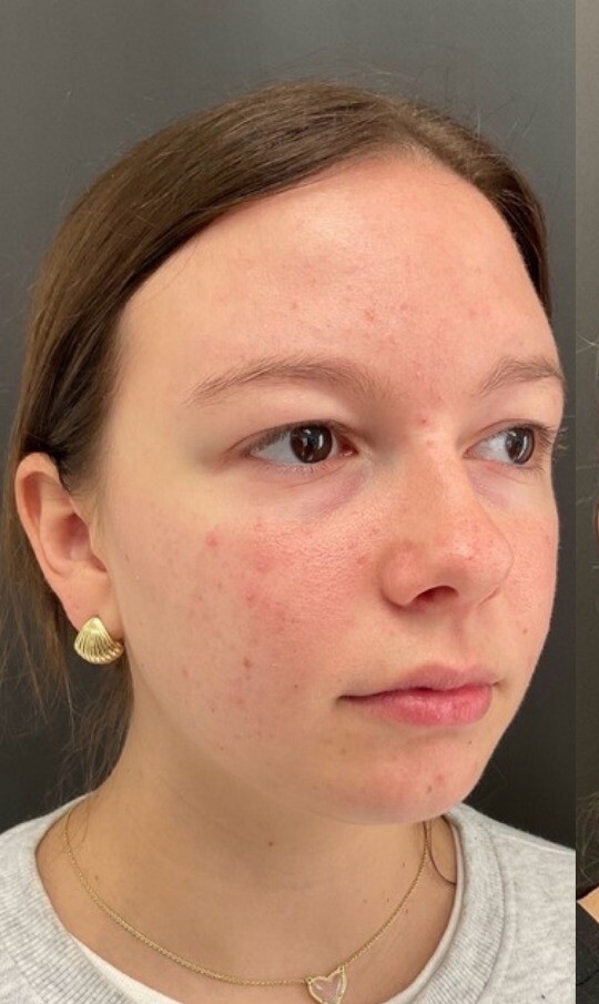 Facial Balancing + Skincare: before at Chin Up Aesthetics