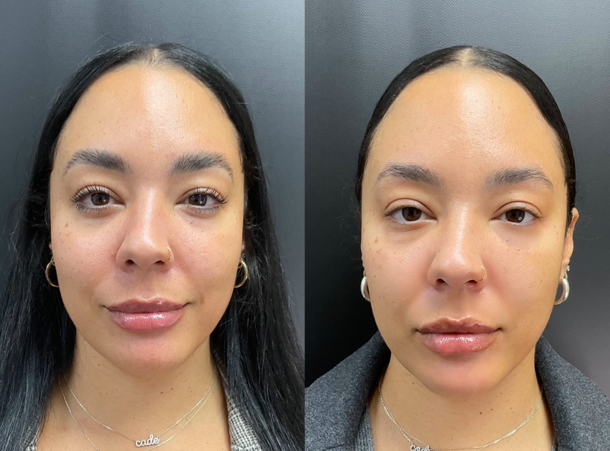 Smile Lines & Lips: before and after, Facial Balancing at Chin Up Aesthetics