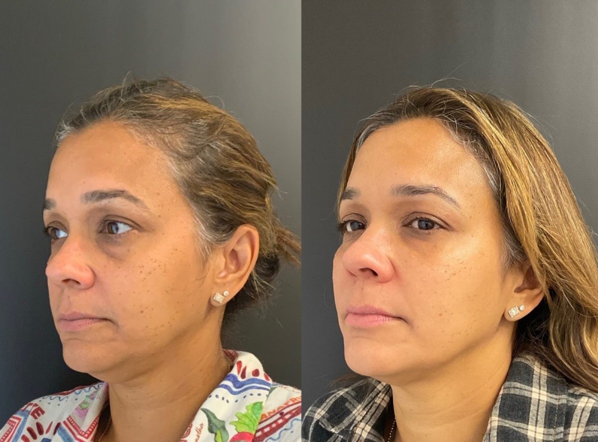 Facial Balancing & Under Eye Correction: before and after, Facial Balancing at Chin Up Aesthetics