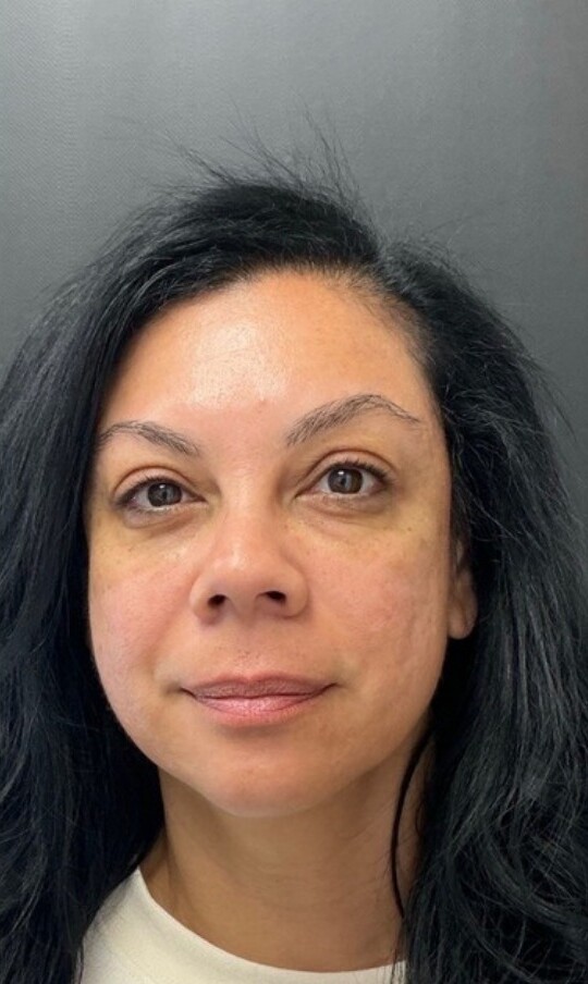 Facial Balancing and Undereye Correction: after at Chin Up Aesthetics