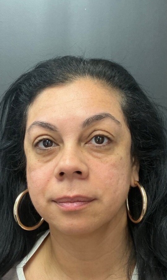 Facial Balancing and Undereye Correction: before at Chin Up Aesthetics