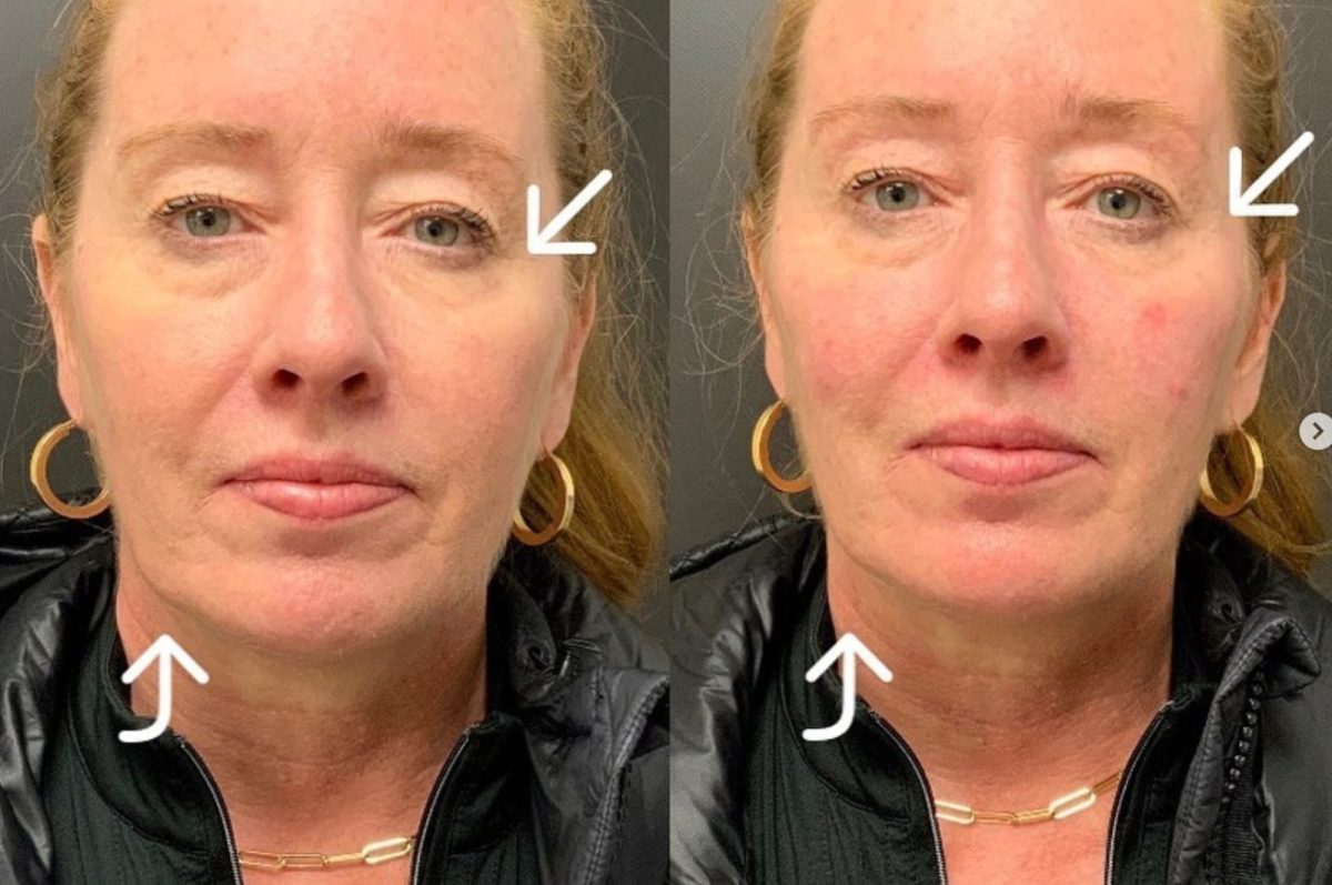 Undereye Correction: before and after, Facial Balancing at Chin Up Aesthetics