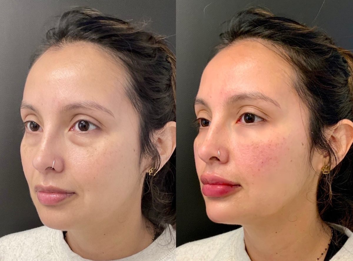 Undereye Correction: before and after, Facial Balancing at Chin Up Aesthetics