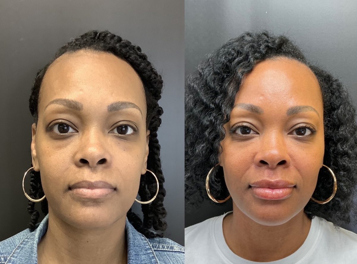 Undereye Correction: before and after, Facial Balancing at Chin Up Aesthetics