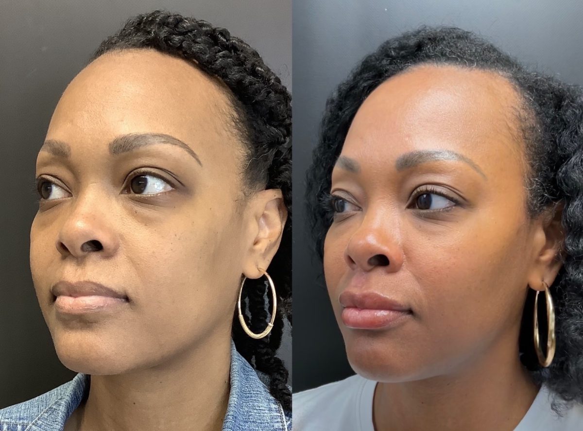 Undereye Correction: before and after, Facial Balancing at Chin Up Aesthetics