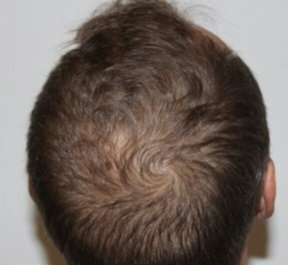 Hair Rejuvenation: after at Chin Up Aesthetics