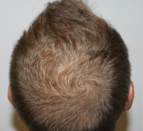 Hair Rejuvenation: before at Chin Up Aesthetics