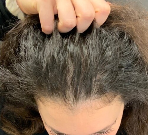 Hair Rejuvenation: after at Chin Up Aesthetics