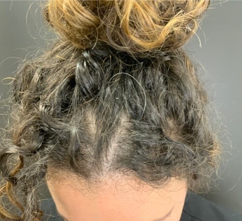 Hair Rejuvenation: before at Chin Up Aesthetics