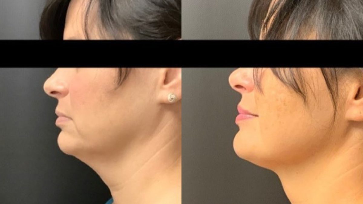 Kybella: before and after, Kybella at Chin Up Aesthetics