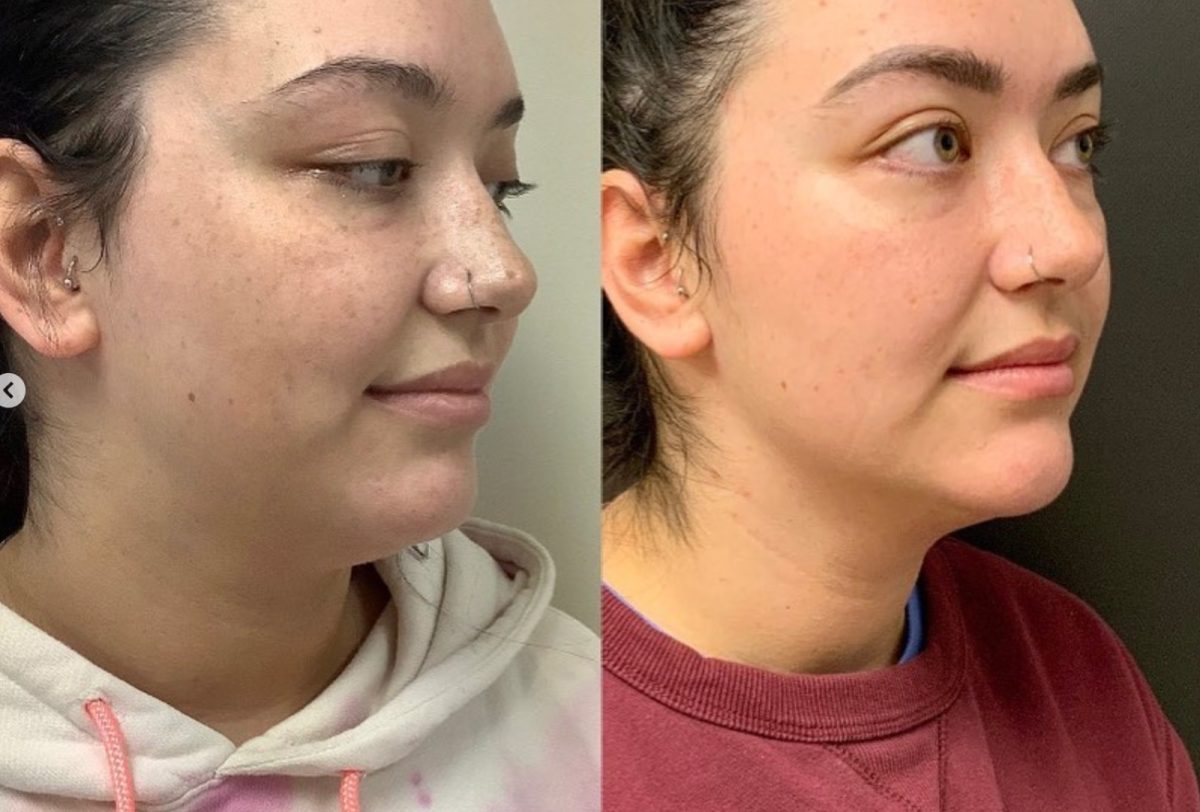 Kybella: before and after, Kybella at Chin Up Aesthetics