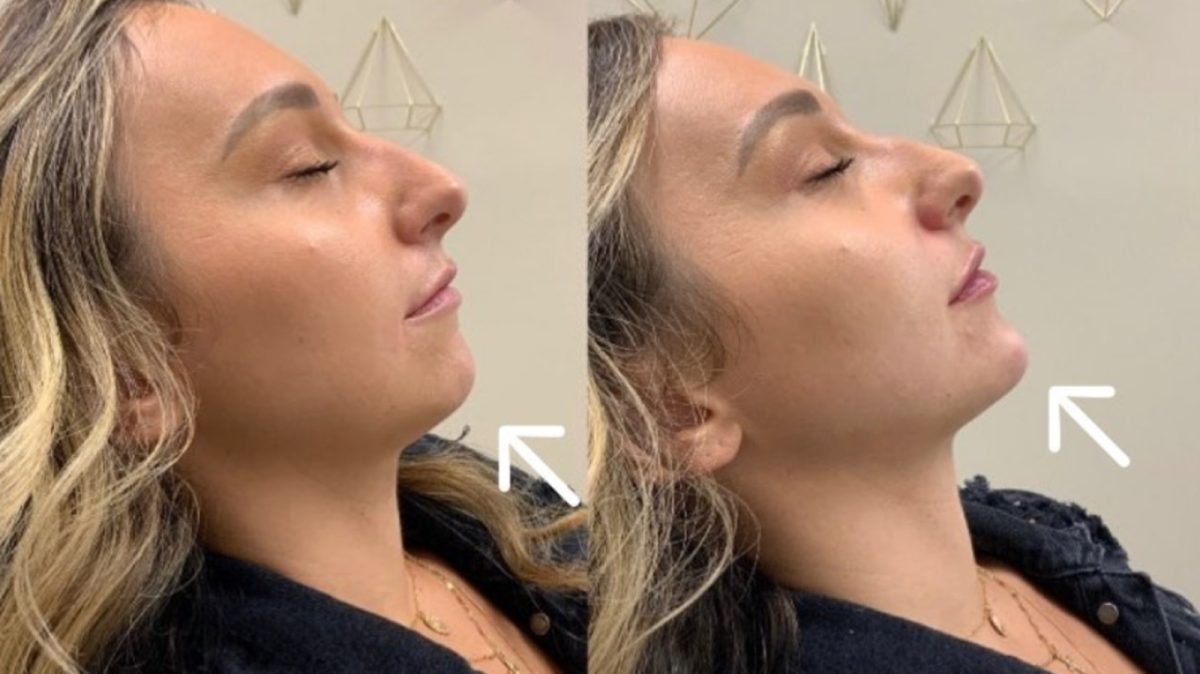 Kybella & Chin Filler: before and after, Kybella at Chin Up Aesthetics
