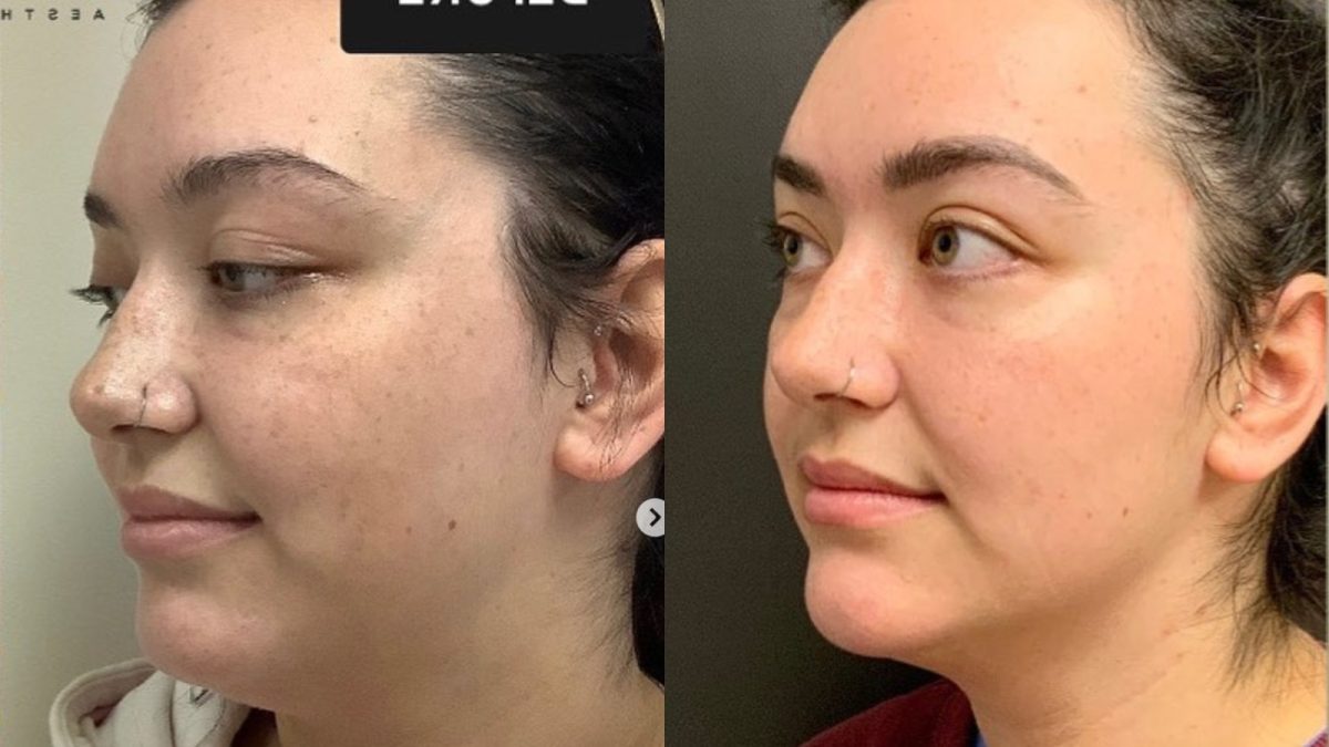 Kybella & Chin Filler: before and after, Kybella at Chin Up Aesthetics