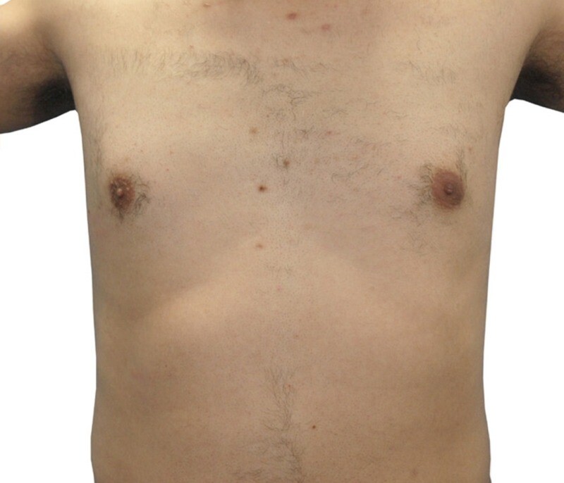 Laser Hair Removal: after at Chin Up Aesthetics