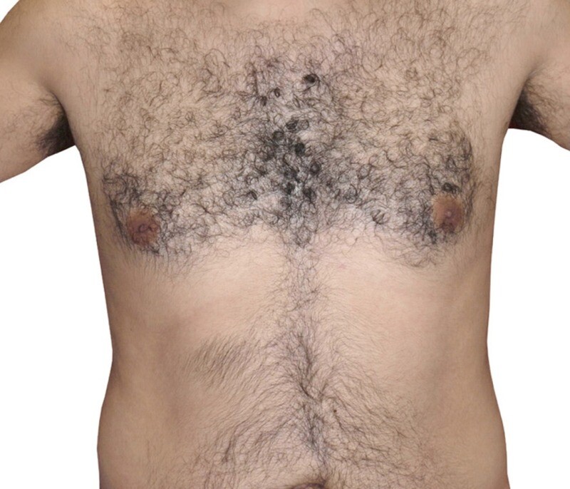 Laser Hair Removal: before at Chin Up Aesthetics