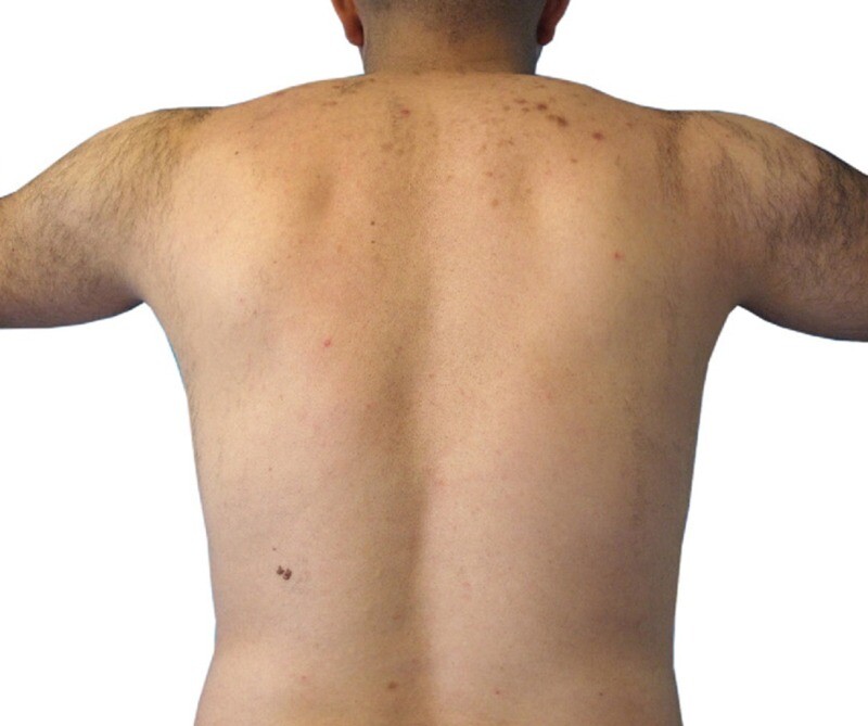 Laser Hair Removal: after at Chin Up Aesthetics