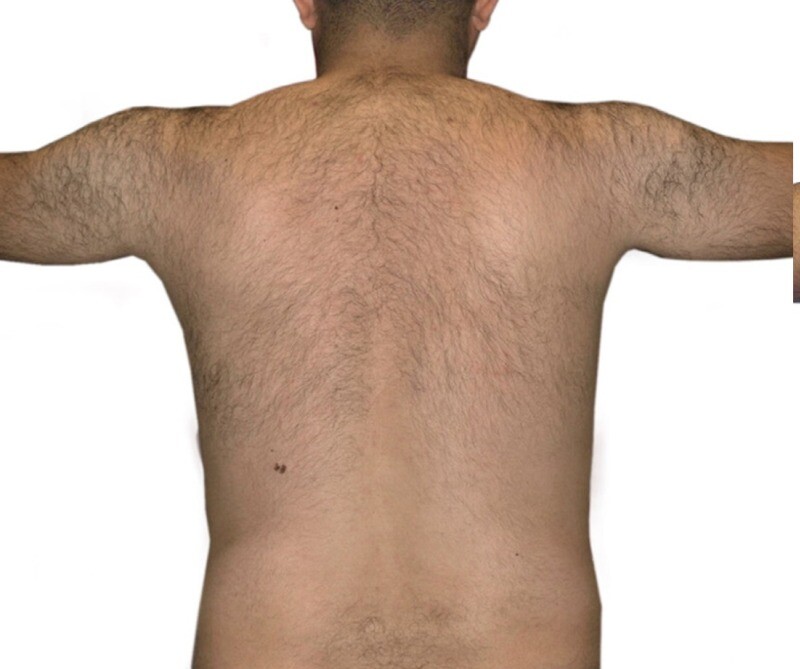 Laser Hair Removal: before at Chin Up Aesthetics