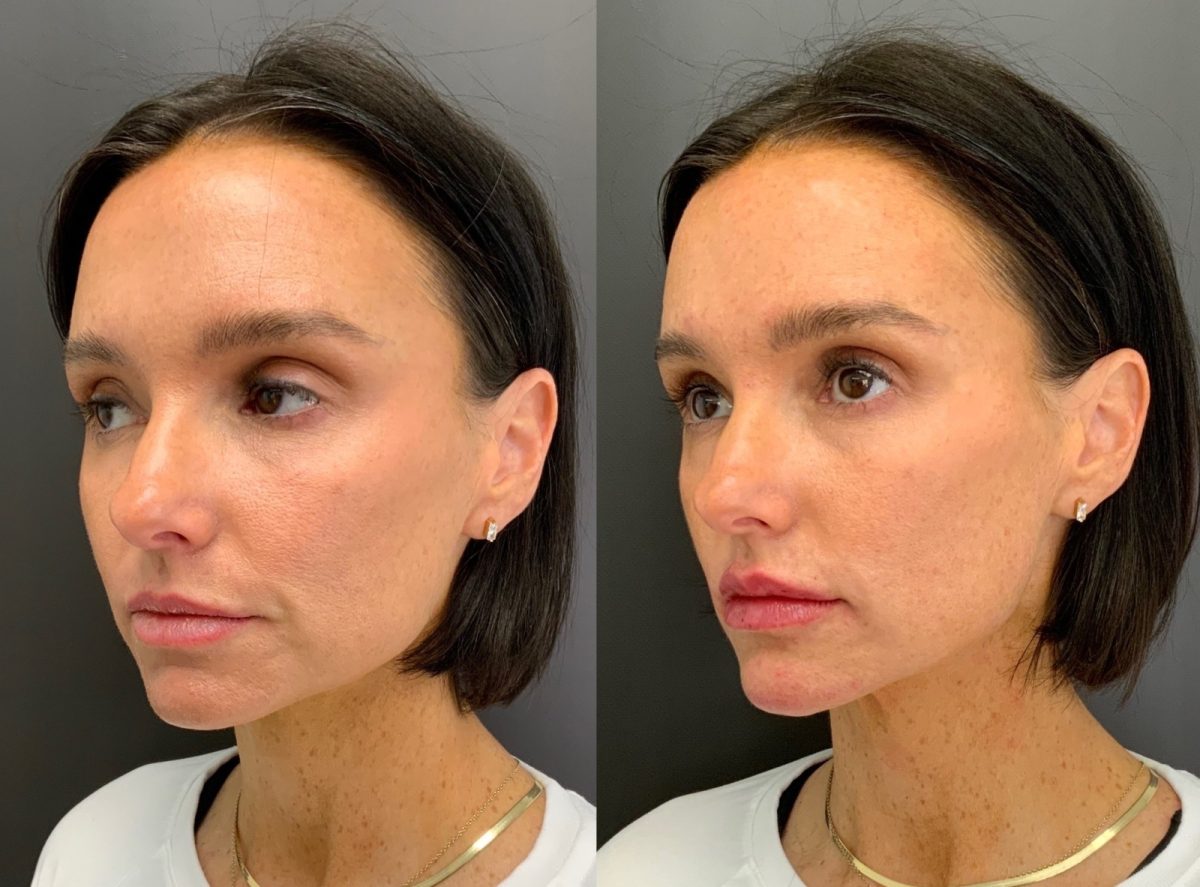 Lip Filler: before and after, Lip Filler at Chin Up Aesthetics