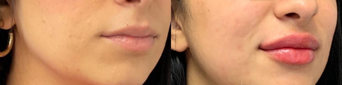 Lip Filler: before and after, Lip Filler at Chin Up Aesthetics