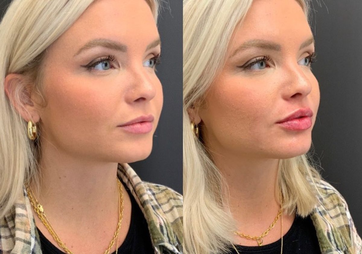 Lip Filler: before and after, Lip Filler at Chin Up Aesthetics