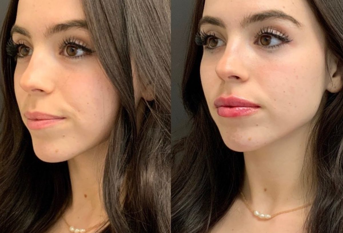 Lip Filler: before and after, Lip Filler at Chin Up Aesthetics