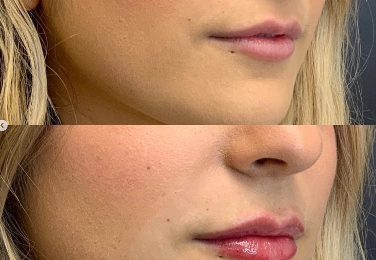 Lip Filler: before and after, Lip Filler at Chin Up Aesthetics