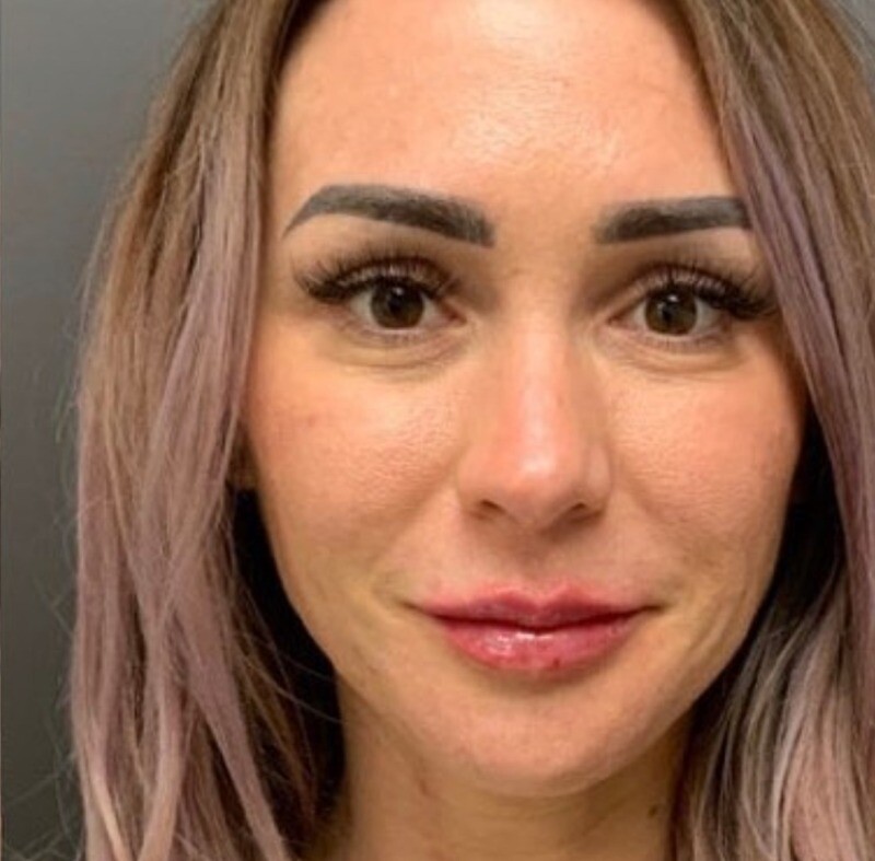Lip Filler: after at Chin Up Aesthetics