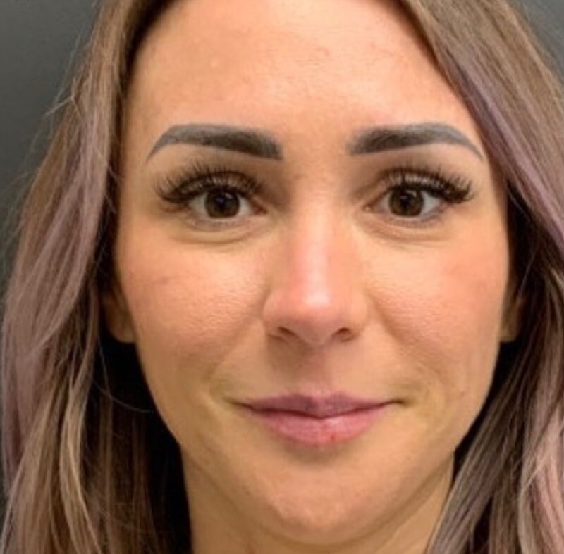 Lip Filler: before at Chin Up Aesthetics