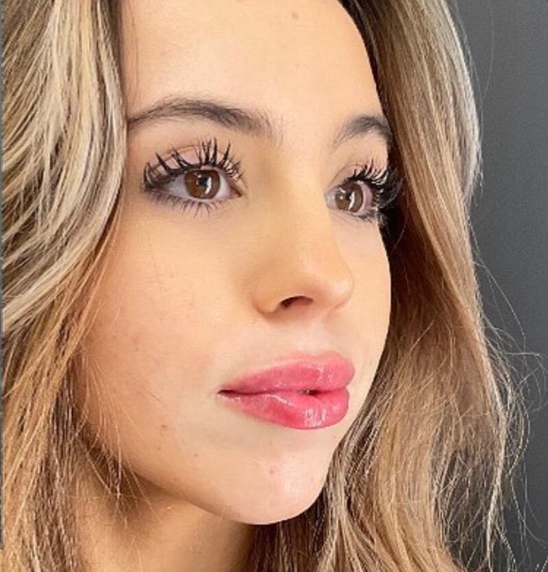 Lip Filler: after at Chin Up Aesthetics