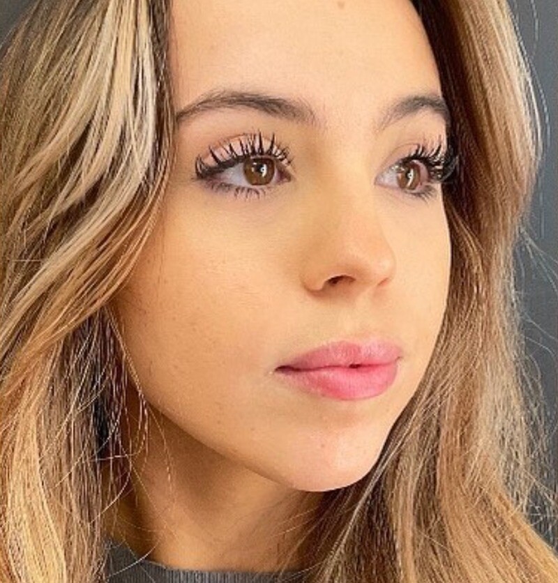 Lip Filler: before at Chin Up Aesthetics
