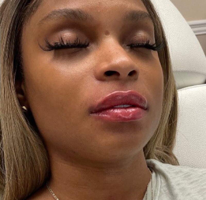 Lip Filler: after at Chin Up Aesthetics