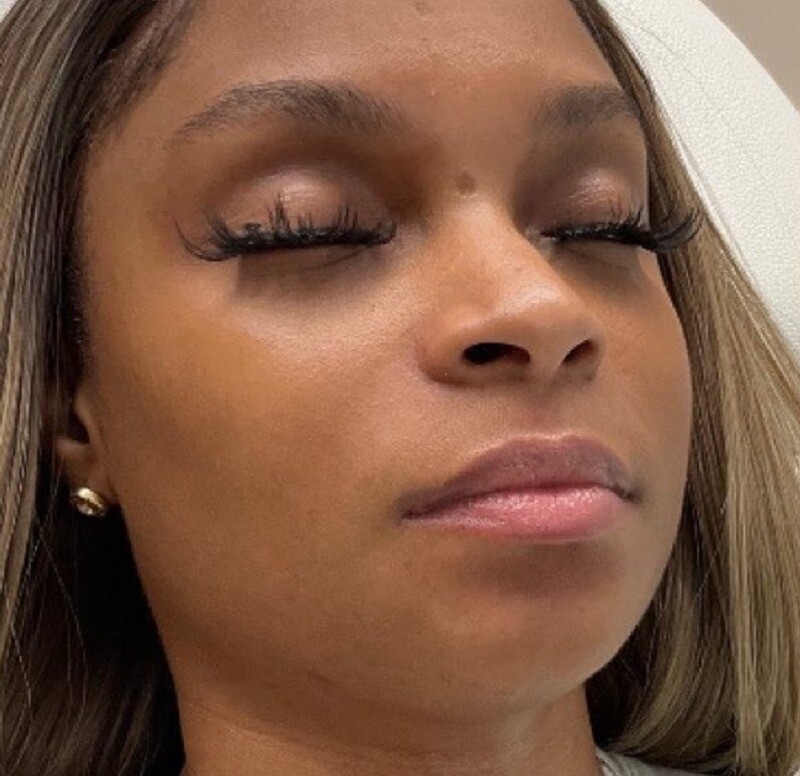 Lip Filler: before at Chin Up Aesthetics