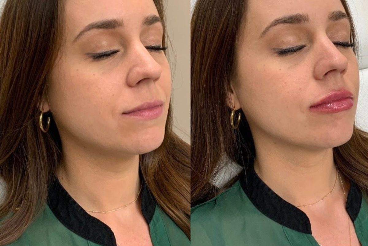 Lip Filler: before and after, Lip Filler at Chin Up Aesthetics