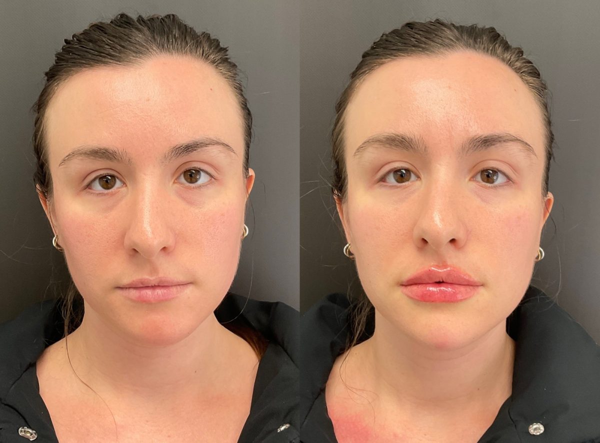 Lip Filler: before and after, Lip Filler at Chin Up Aesthetics