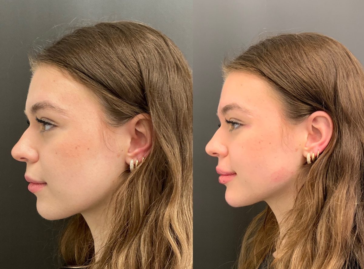 Lip Filler: before and after, Lip Filler at Chin Up Aesthetics