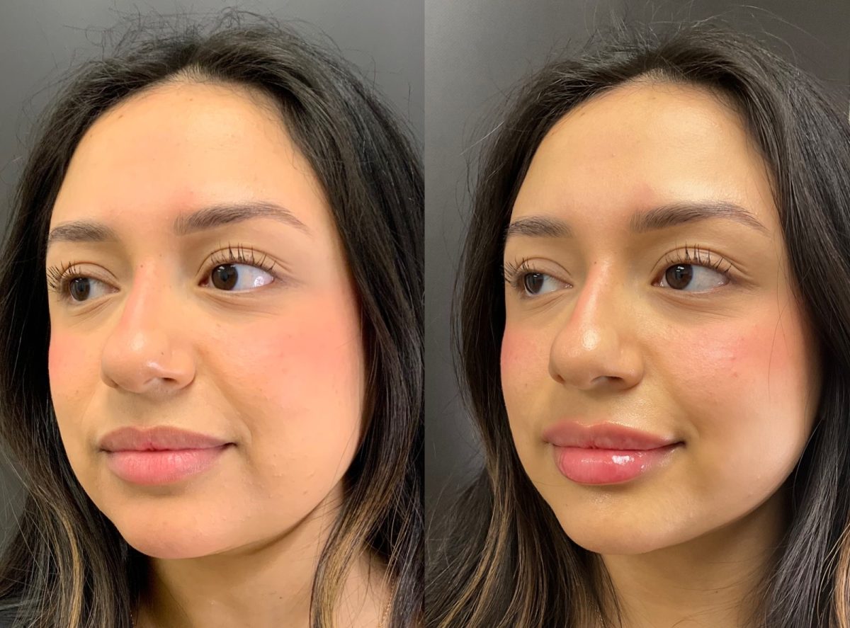 Lip Filler: before and after, Lip Filler at Chin Up Aesthetics