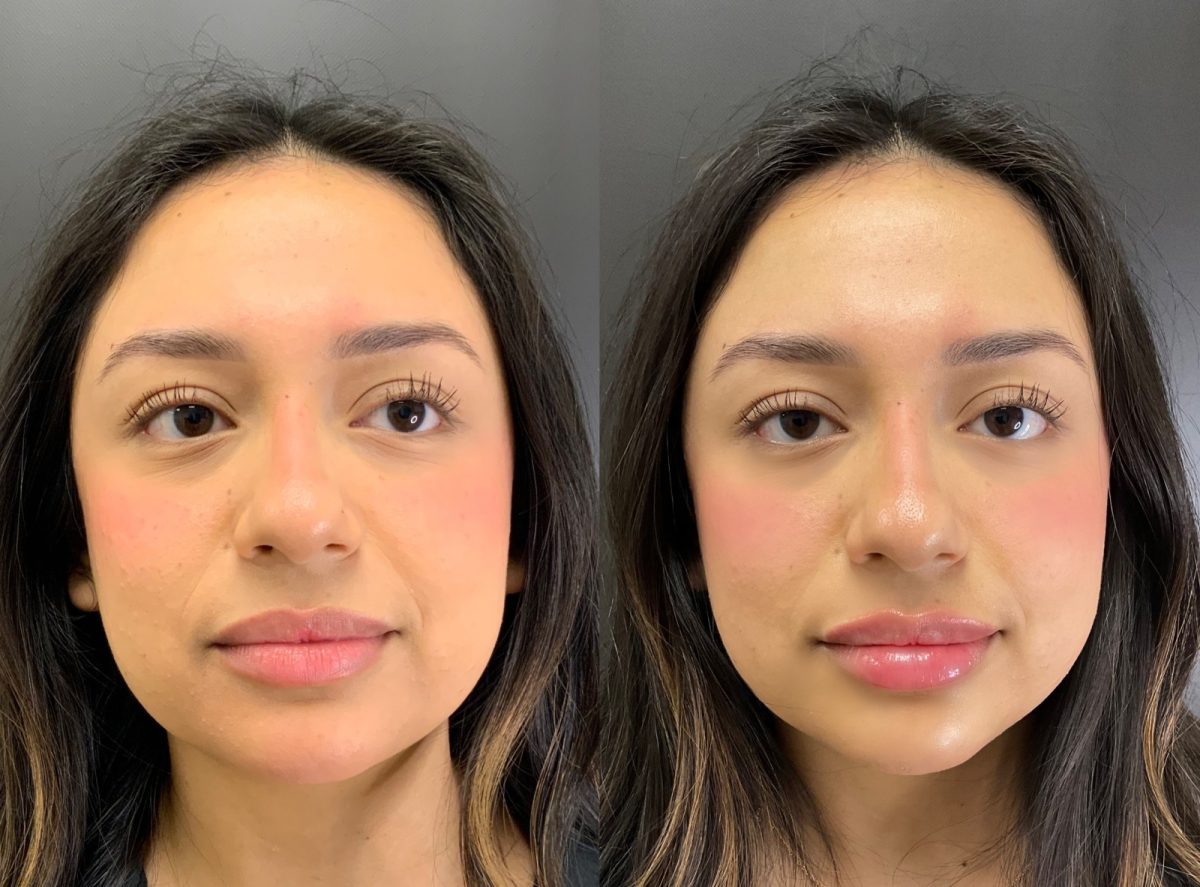 Lip Filler: before and after, Lip Filler at Chin Up Aesthetics