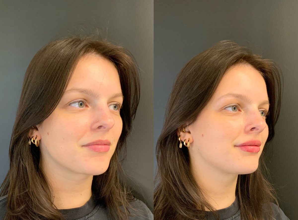 Lip Filler: before and after, Lip Filler at Chin Up Aesthetics