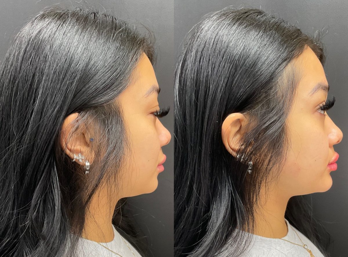 Lip Filler: before and after, Lip Filler at Chin Up Aesthetics