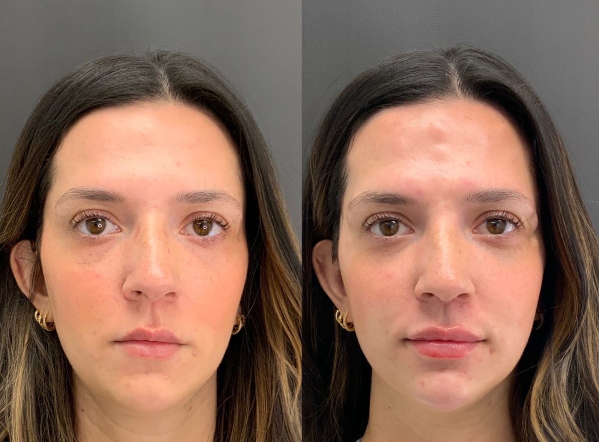 Lip Filler: before and after, Lip Filler at Chin Up Aesthetics