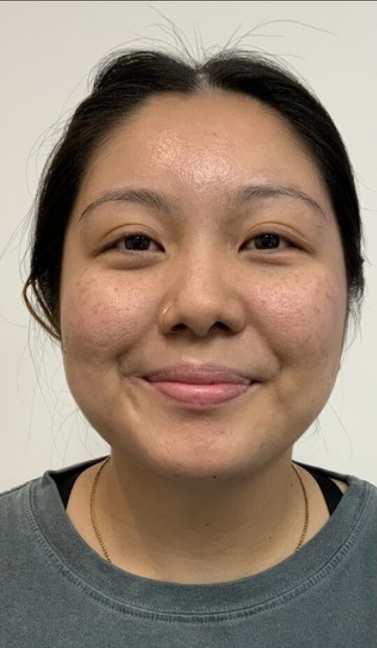 Microneedling: before at Chin Up Aesthetics